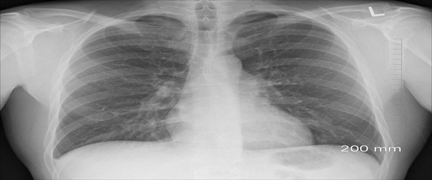 X-ray showing respiratory disease in person’s lungs.